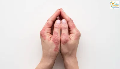 Аллергия на антисептики, или Чем может обернуться забота о чистоте рук -  Все про аллергию