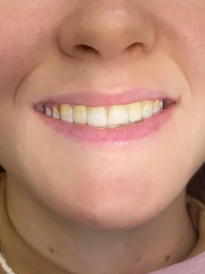 Коронки из циркония, 22, 12 зубы | Примеры работ - фото до и после