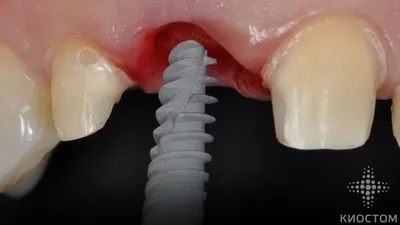 Безметалловые коронки на передние зубы: фото до и после | Киостом