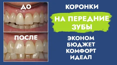 Коронки на передние зубы до и после фотографии