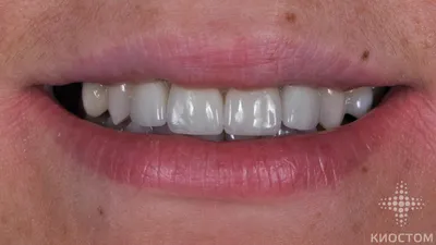 Безметалловые коронки на передние зубы: фото до и после | Киостом