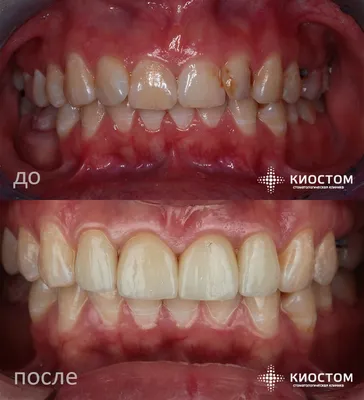 Коронки на зубы в Самаре: цена, поставить зубную коронку | Киостом