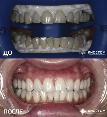 Протезирование зубов в Самаре: цены на съемные и несъемные протезы |  Стоматология Киостом