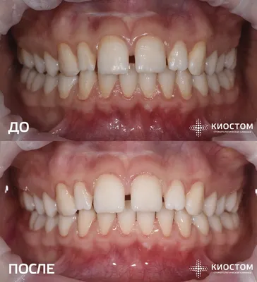 Протезирование зубов в Самаре: цены на съемные и несъемные протезы |  Стоматология Киостом