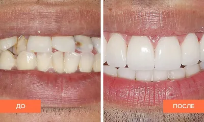 Коронки на передние зубы до и после [91 фото]