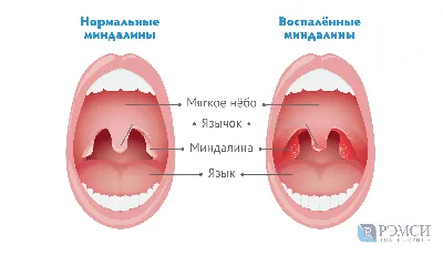 Как отличить ангину от гриппа