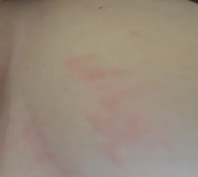 Красное пятно на груди у женщины - Вопрос дерматологу - 03 Онлайн