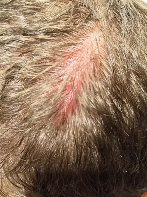 Красные пятна на коже головы (фото) Форум