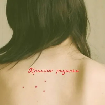 О чем говорят красные точки-родинки на теле, рассказала дерматолог Мошкова  | DOCTORPITER