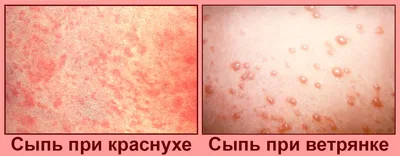 Сыпь с температурой: причины, лечение - Симптомы болезни и признаки  заболеваний