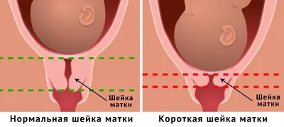 Длина шейки матки при беременности. Нормы длины шейки матки по неделям  беременности — Беременность. Беременность по неделям.