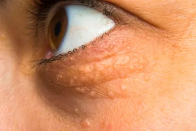 Ксантелазма навколо очей - причини і лікування - Приватна клініка \