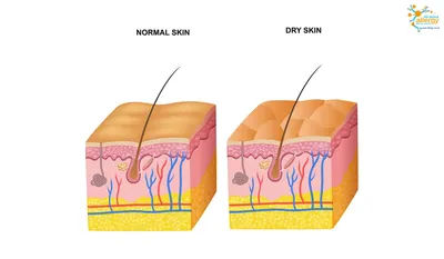 Сухая кожа: почему возникает, как выглядит и как ее избежать? - Все про  аллергию