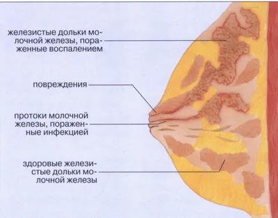 Лактостаз у кормящей матери - симптомы и лечение в домашних условиях:  (много видео)