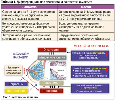 Лактостаз: тактические контраверсии — Extempore