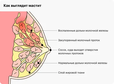 Как лечить лактостаз и мастит