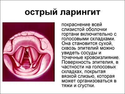 Ларингит - это не просто охриплость голоса