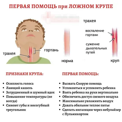 Ложный круп или как правильно - острый обструктивный ларингит (он же  ларинготрахеит) | Пикабу