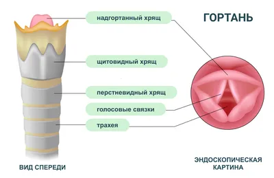 Как лечить острый ларингит