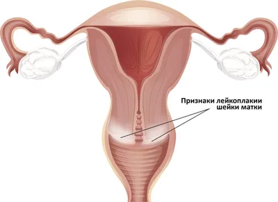 Лечение лейкоплакии шейки матки в Москве в клинике Марины Рябус