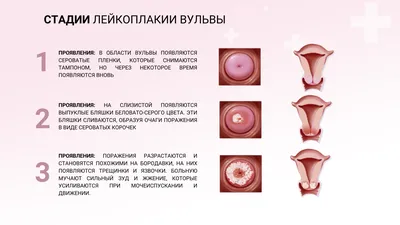 Плазмотерапия при лейкоплакии вульвы | Достоинства плазмы | MedicalCase