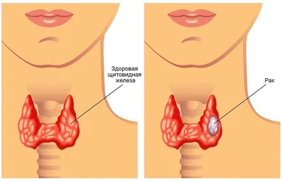 Лимфостаз руки после удаления молочной железы | Отзыв Татьяны на лечение  лимфедемы после мастэктомии