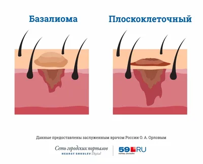 Рак молочной железы: первые признаки и симптомы рака груди, причины  появления и стадии опухоли молочной железы | Клиники «Евроонко»