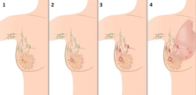 Рак молочной железы — (клиники Di Центр)