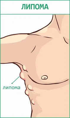 Удаление липомы (жировика) у ребенка - цена процедуры в СПб