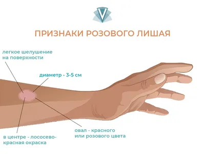 Лечение розового лишая Жибера в Одессе и Киеве - дерматология Виртус