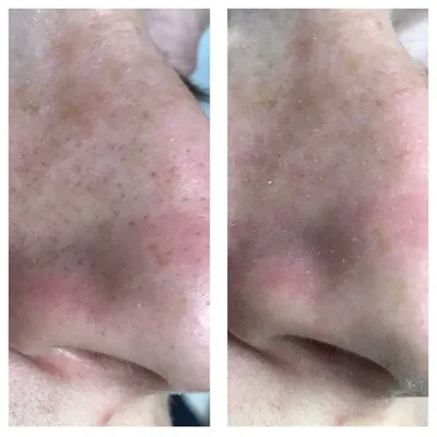 Фото до и после Чистка лица у косметолога — Сеть косметологических клиник  Эпилайк