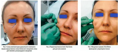 Особенности коррекции носослезной борозды у пациенток с эндокринопатиями -  Beauty Expert