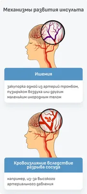 Восстановление после инсульта: речь, зрение, память, моторика и другие  функции