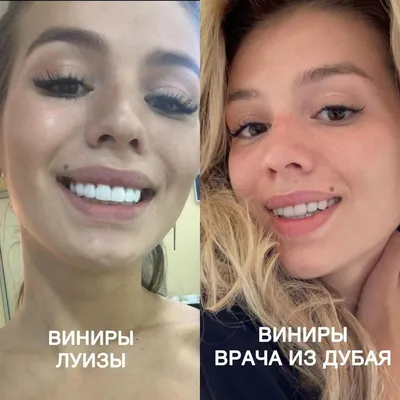 Скандал с участием Люси Чеботиной и ее стоматолога продолжается: выясняем,  на чьей стороне люди | Super.ru | Дзен