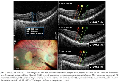 Рис. П-т К., 66 лет. МКОЗ до операции 0,09 н/к. Идиопатический макулярный  разрыв закрыт по технологии «височный перевернутый лоскут ВПМ» (фото). ОКТ:  через 1 мес. после операции сохраняются дефекты ELM (красная стрелка),