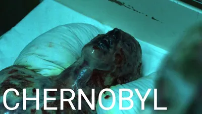 ЛУЧЕВАЯ болезнь НАС ПОГУБИТ / Чернобыль лучшие моменты / Чернобыль HBO  лучшие моменты - YouTube