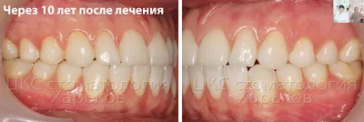 О стоматологии и не только...: Зубы мудрости (восьмерки) делают зубы  неровными