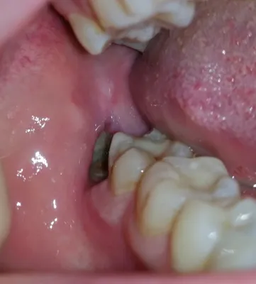 Не заживает лунка после удаления зуба - Вопрос стоматологу - 03 Онлайн