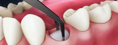 Заживление лунки после удаления зуба Стоматология Dental Way в Москве и  Московской области | Dental Way