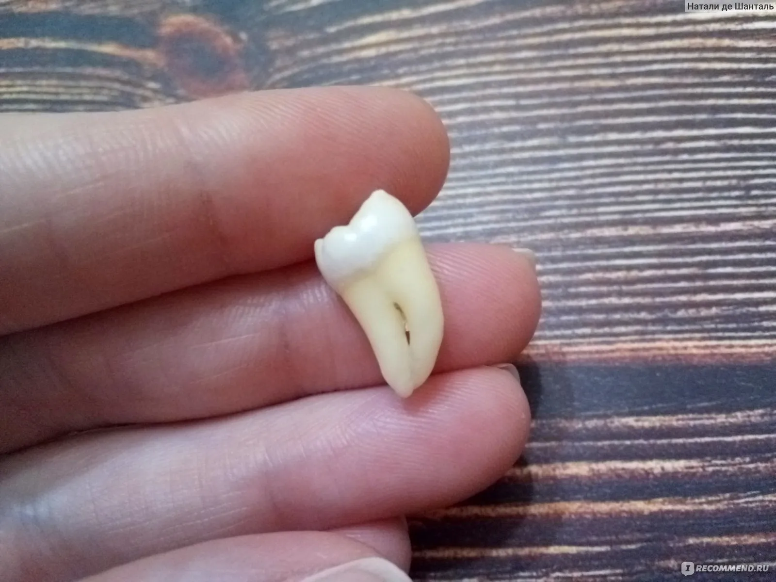 Сонник выпадение зубов без крови. Как выглядит удаленный зуб. Заживление зуба мудрости. Удаленный зуб мудрости фото.