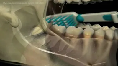 Удаление зубов мудрости (8-ки) в СПб — лучшая цена удаления ретинированного  дистопированного зуба
