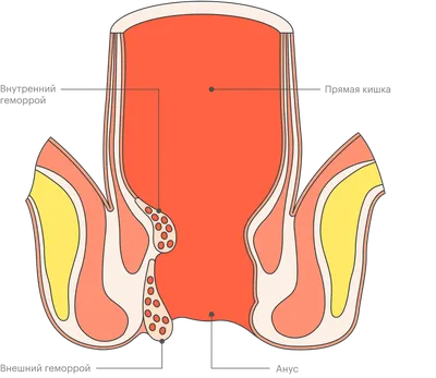 Геморрой: симптомы, лечение, как выглядит, что нельзя делать, причины,  наружный и внутренний, операция, геморрой при беременности