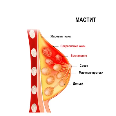 Мастит - причины появления, симптомы заболевания, диагностика и способы  лечения