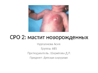 Мастит новорожденных | Презентации Детская хирургия | Docsity