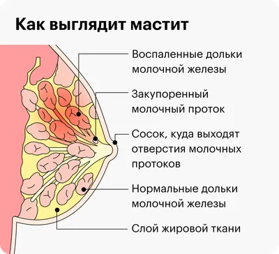 Как лечить лактостаз и мастит