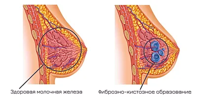 Мастопатия и боль в груди