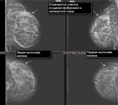 Диффузная фиброзная мастопатия на маммографии | Второе мнение