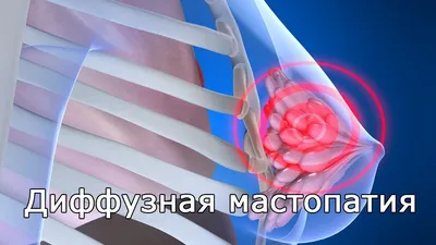 Диффузная мастопатия - признаки, причины, симптомы, лечение и профилактика  - iDoctor.kz