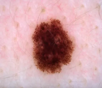 Меланома кожи - ранняя диагностика меланомы в клинике лазерной хирургии  «Градиент» в Москве