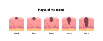 Меланома кожи: лечение, стадии, симптомы, как выглядит меланома и какими  препаратами лечить